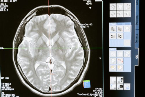 traumatic brain injury (TBI)